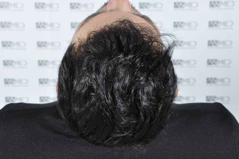 norwood4 4205-grafts-FUE 3year5months 11