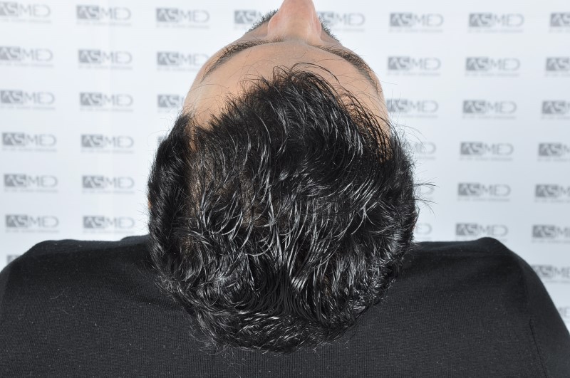 norwood4 4205-grafts-FUE 3year5months 12