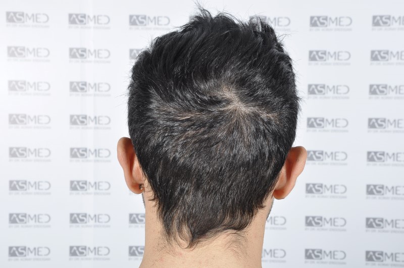 norwood4 4205-grafts-FUE 3year5months 13