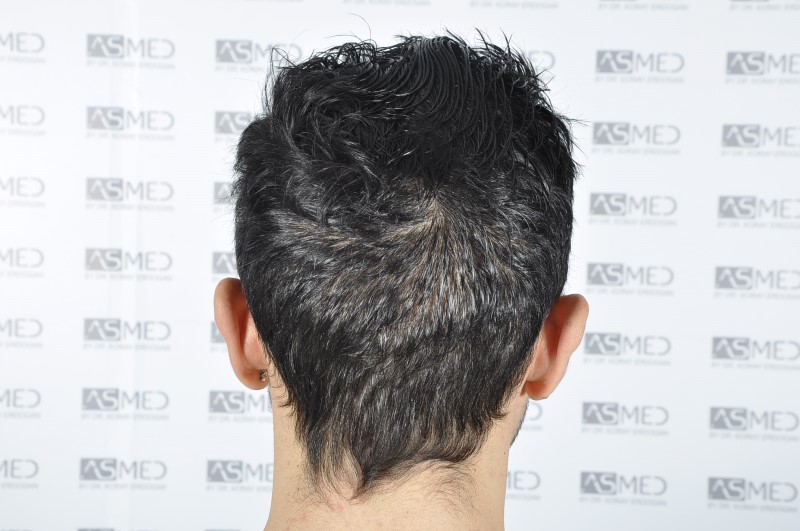 norwood4 4205-grafts-FUE 3year5months 14