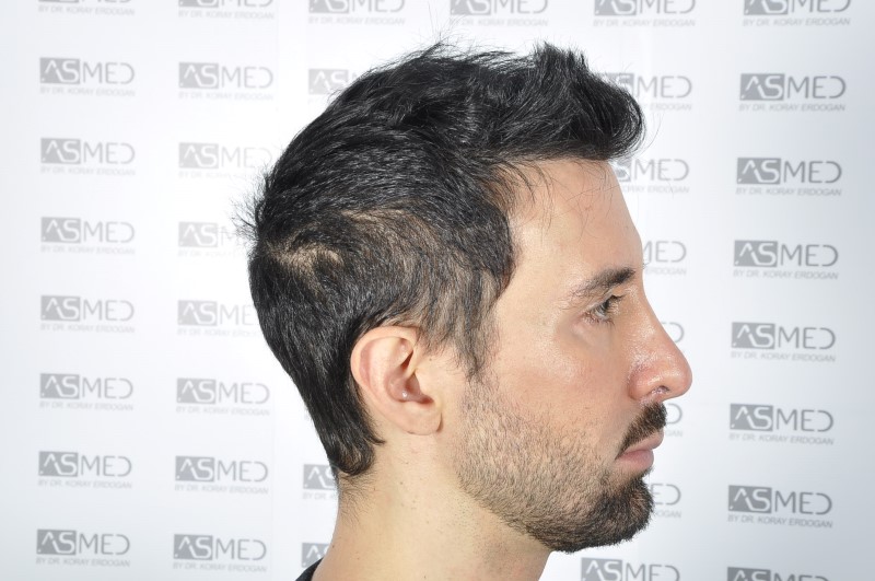 norwood4 4205-grafts-FUE 3year5months 5