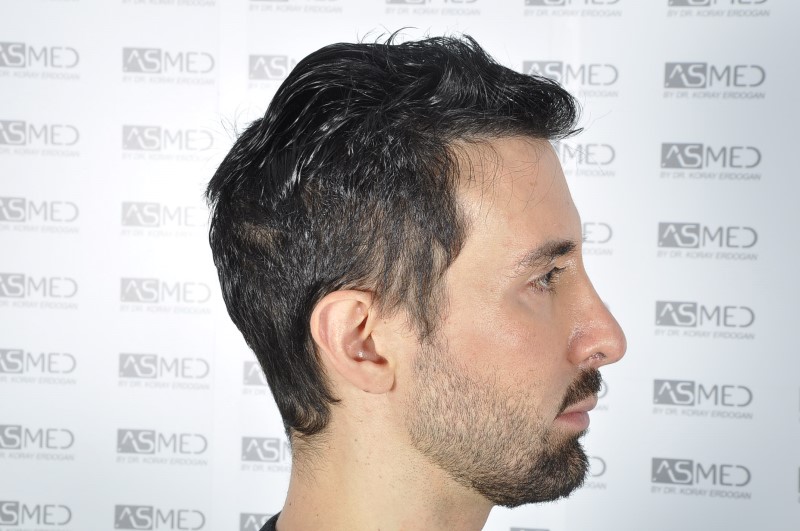 norwood4 4205-grafts-FUE 3year5months 6