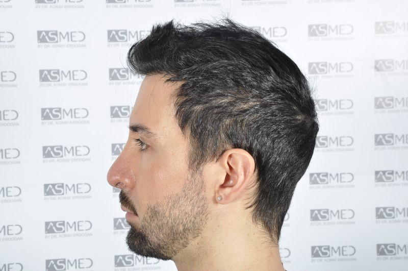 norwood4 4205-grafts-FUE 3year5months 7