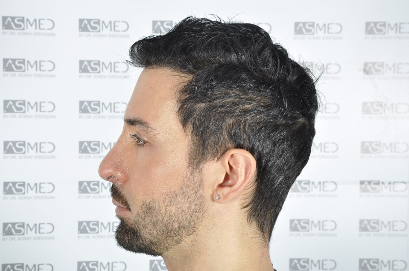 norwood4 4205-grafts-FUE 3year5months 8