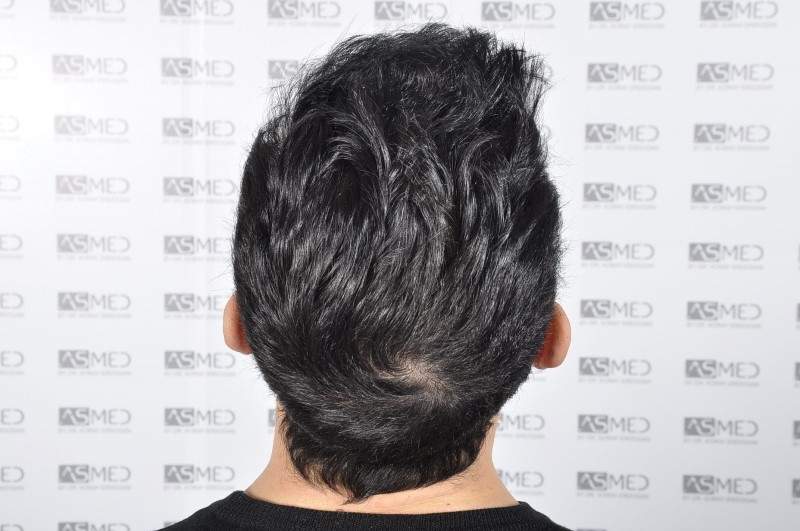 norwood4 4205-grafts-FUE 3year5months 9