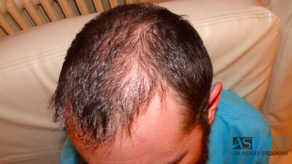 norwood4 4425-grafts-FUE-2200-FUE_2225-FUE 060c5ac9