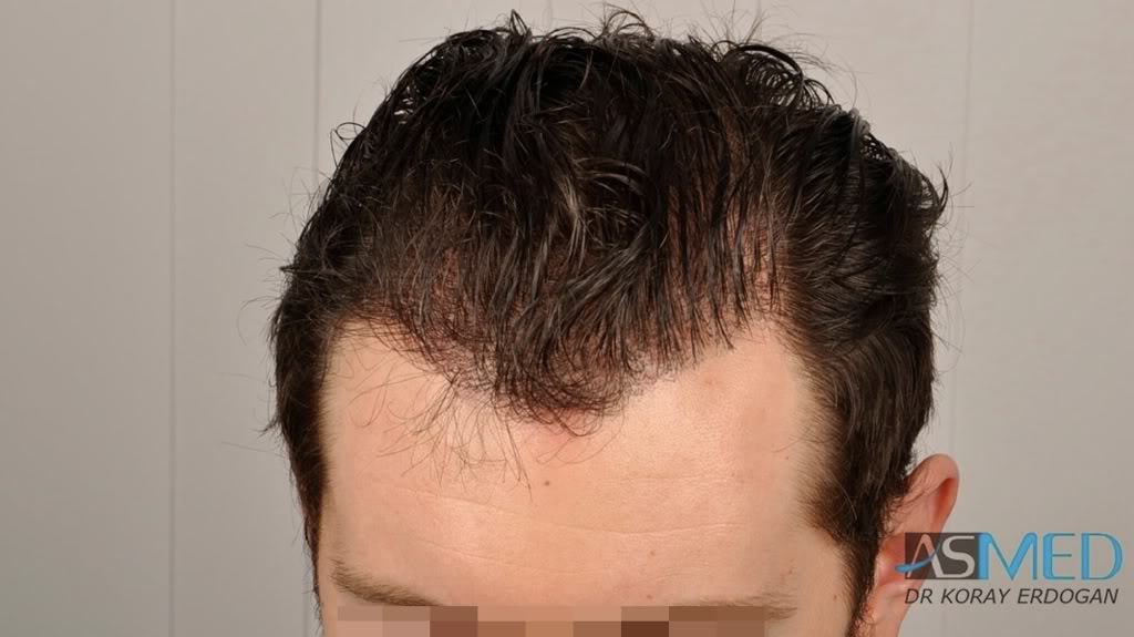 norwood4 4425-grafts-FUE-2200-FUE_2225-FUE 0dc9465e