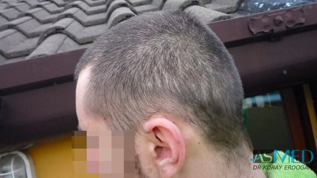 norwood4 4425-grafts-FUE-2200-FUE_2225-FUE 4f34d34a