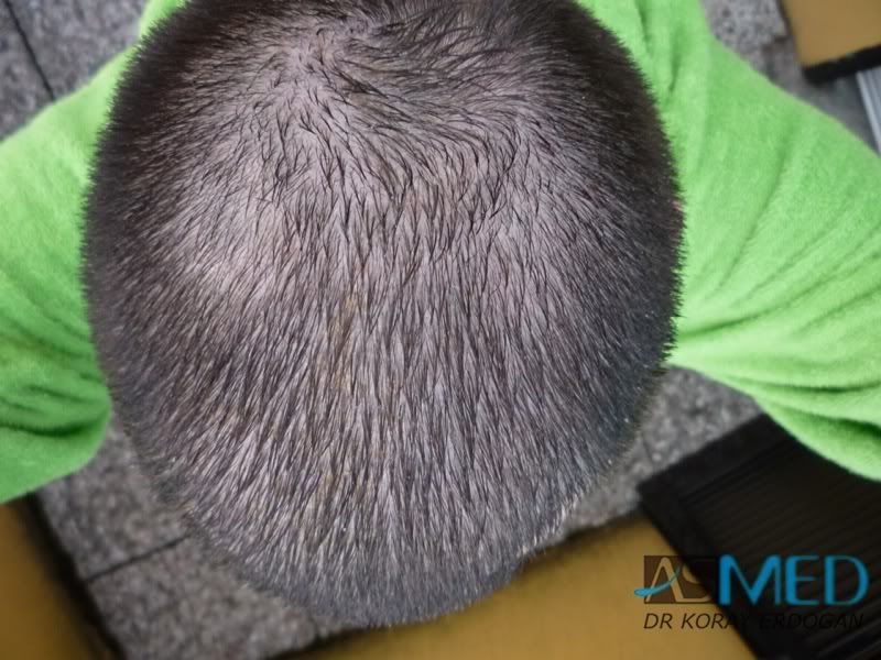 norwood4 4425-grafts-FUE-2200-FUE_2225-FUE be6802af