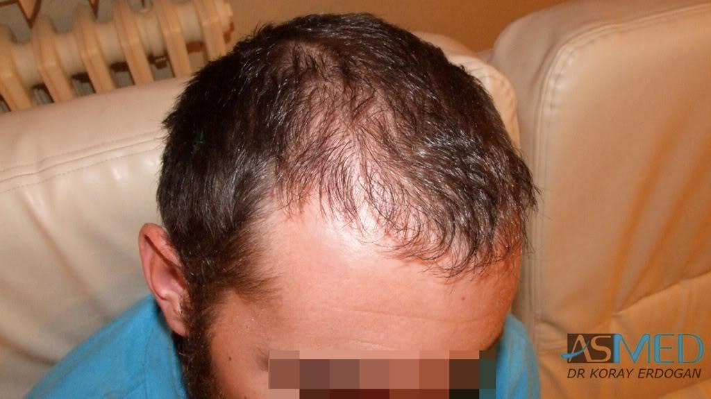 norwood4 4425-grafts-FUE-2200-FUE_2225-FUE fcb6cedd