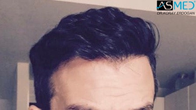 norwood4 5011-grafts-FUE 9months 1
