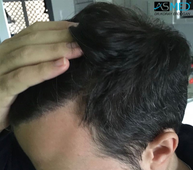 norwood4 5011-grafts-FUE 9months 2