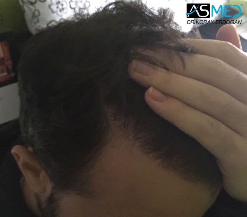 norwood4 5011-grafts-FUE 9months 3