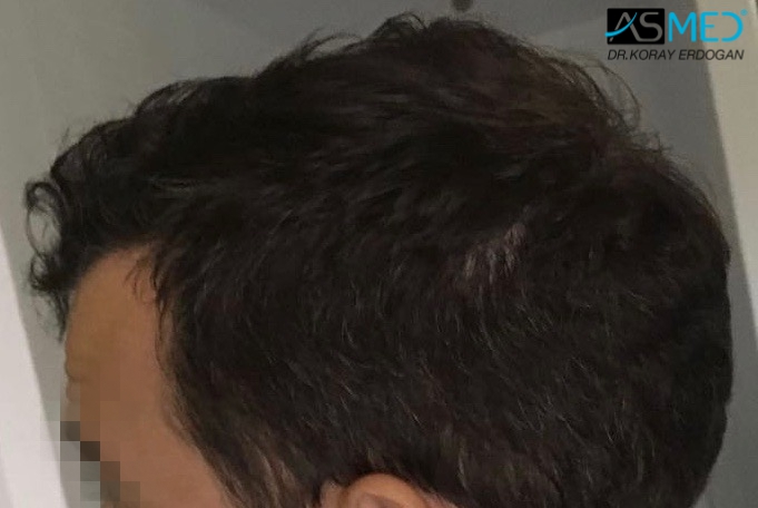 norwood4 5011-grafts-FUE 9months 4