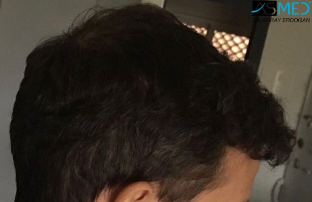 norwood4 5011-grafts-FUE 9months 5