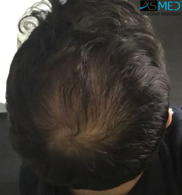 norwood4 5011-grafts-FUE 9months 6
