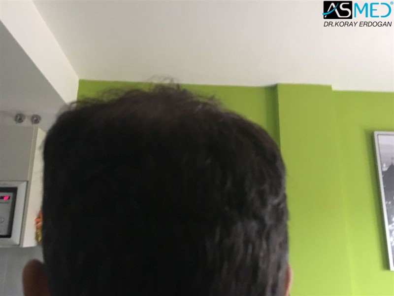 norwood4 5011-grafts-FUE 9months 7