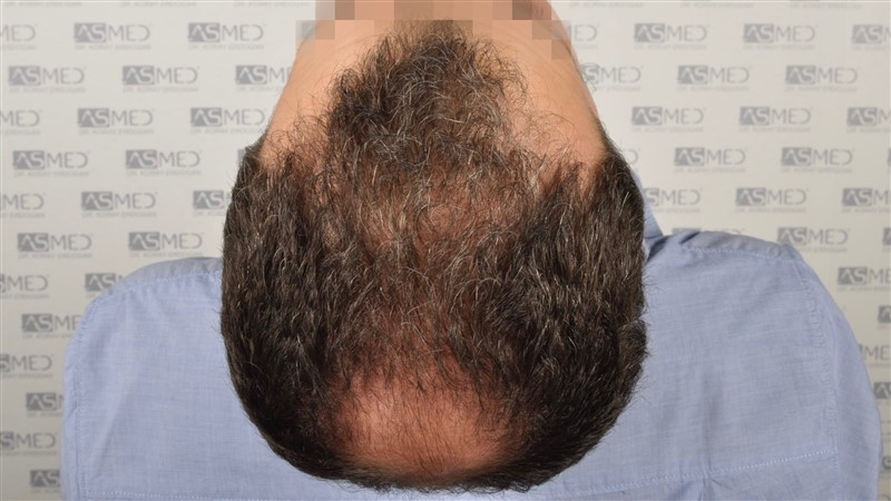 norwood4 5011-grafts-FUE before _DSC7807