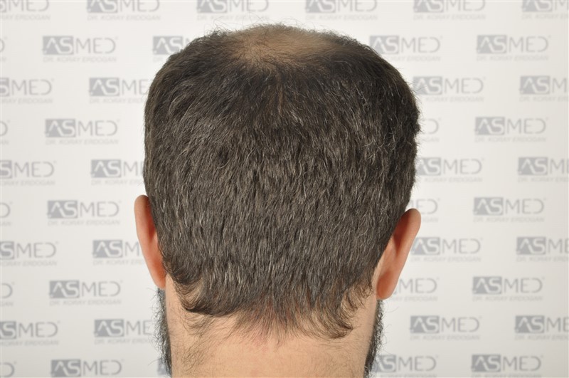 norwood4 5011-grafts-FUE before _DSC7808