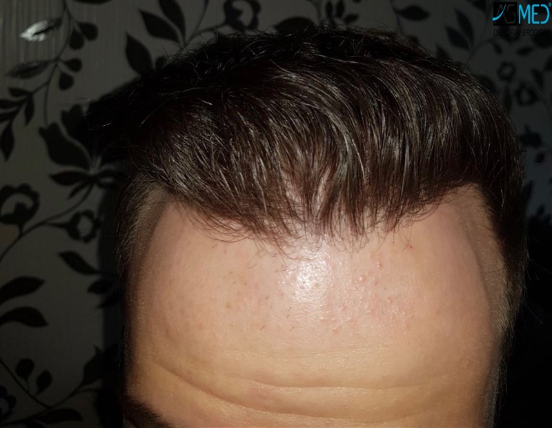 norwood4 5012-grafts-FUE 8months V2_1aaa