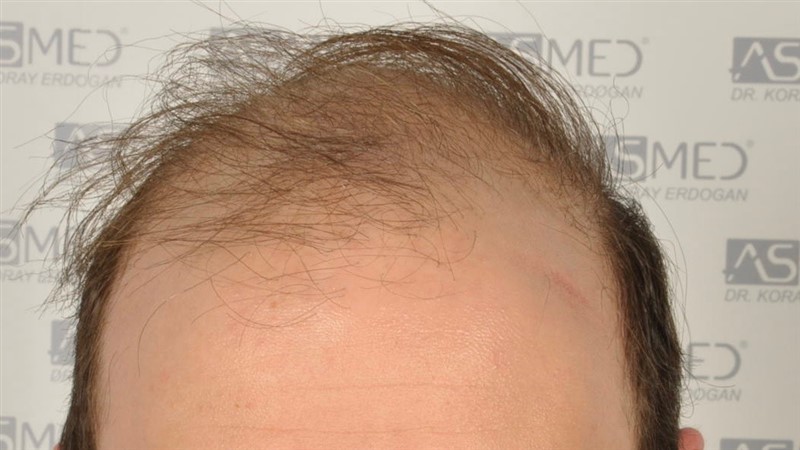 norwood4 5012-grafts-FUE before _DSC0662