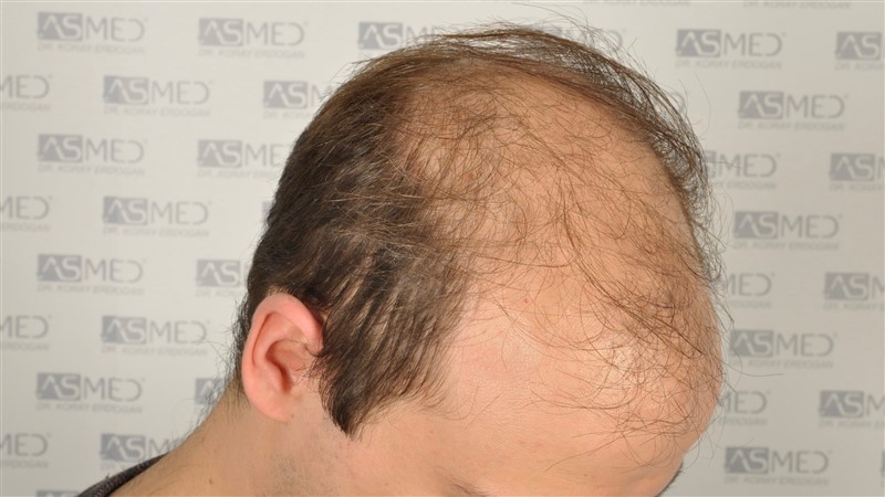 norwood4 5012-grafts-FUE before _DSC0665