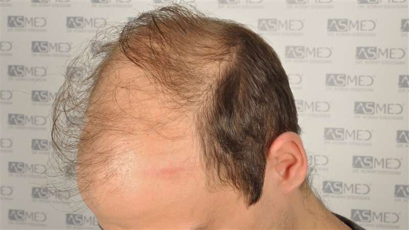 norwood4 5012-grafts-FUE before _DSC0667