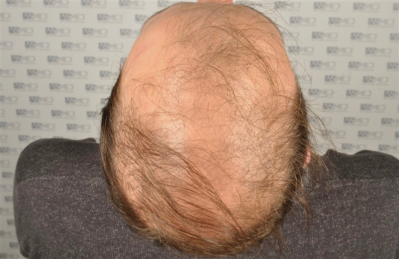 norwood4 5012-grafts-FUE before _DSC0672