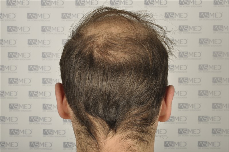 norwood4 5012-grafts-FUE before _DSC0673