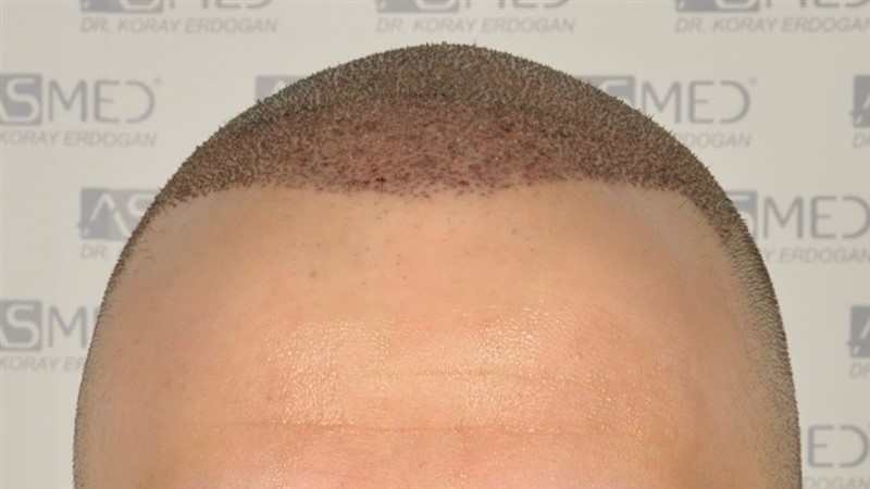 norwood4 5012-grafts-FUE operation _DSC0965