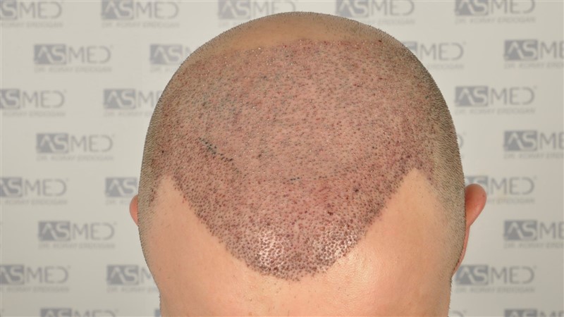 norwood4 5012-grafts-FUE operation _DSC0966