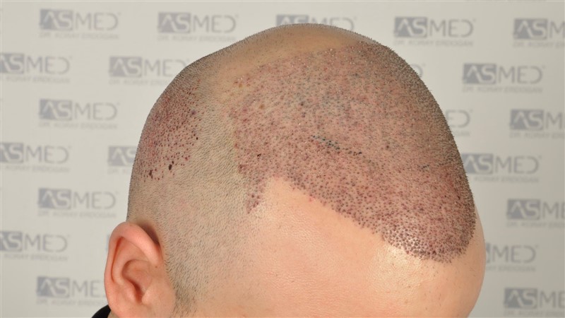 norwood4 5012-grafts-FUE operation _DSC0968