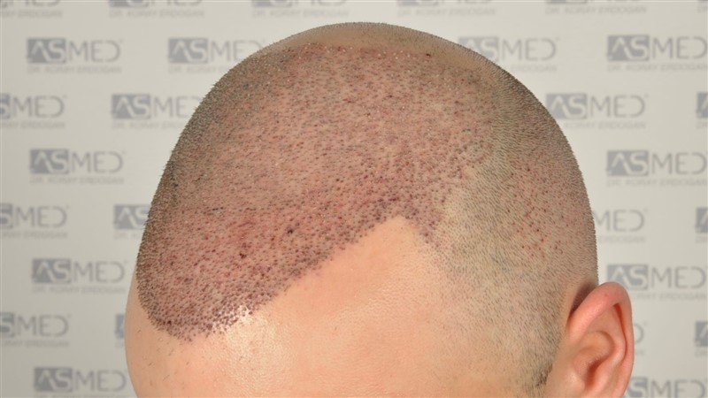 norwood4 5012-grafts-FUE operation _DSC0970