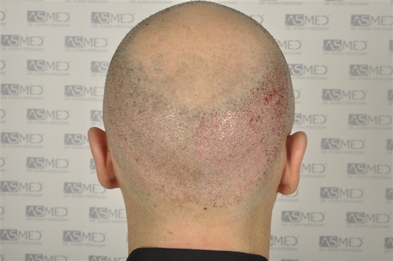 norwood4 5012-grafts-FUE operation _DSC0971