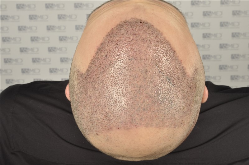 norwood4 5012-grafts-FUE operation _DSC0974