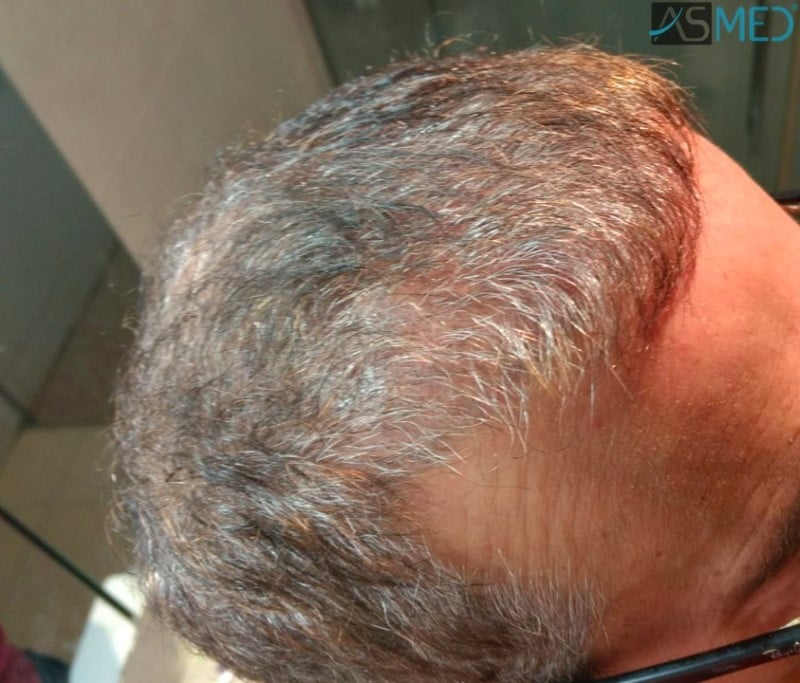 norwood4 5022-grafts-FUE-2 3months WhatsApp%20Image%202018-12-06%20at%2022.05.18(1)_V2