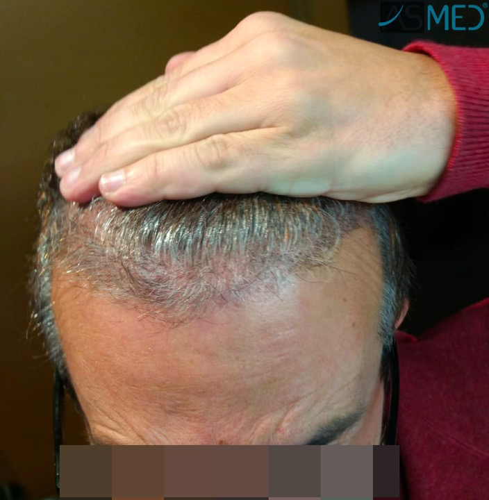 norwood4 5022-grafts-FUE-2 3months WhatsApp%20Image%202018-12-06%20at%2022.05.20(1)_V2