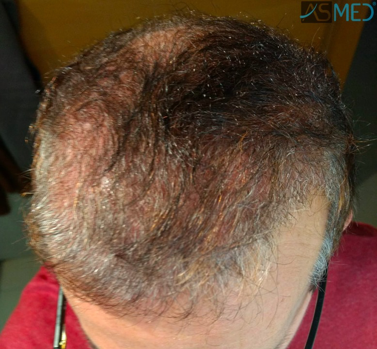 norwood4 5022-grafts-FUE-2 3months WhatsApp%20Image%202018-12-06%20at%2022.05.20_V2
