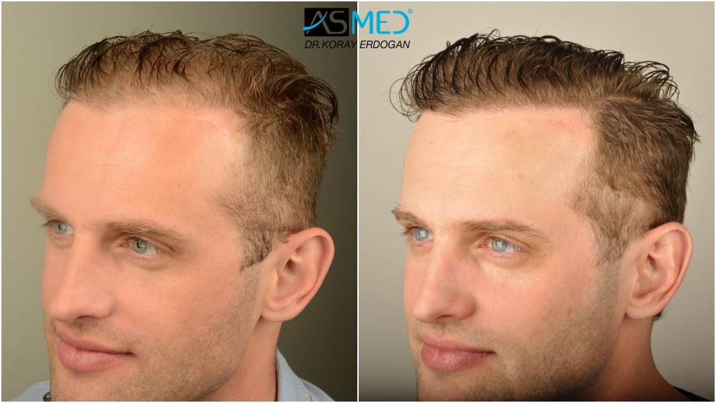 6902 (2700 FUE + 4202 FUE) Grafts Fue | Norwood 5 | Asmed Hair Transplant Results 6902 (2700 FUE + 4202 FUE) Grafts Fue | Norwood 5 | Asmed Hair Transplant Results