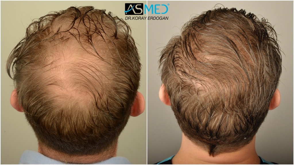 6902 (2700 FUE + 4202 FUE) Grafts Fue | Norwood 5 | Asmed Hair Transplant  Results