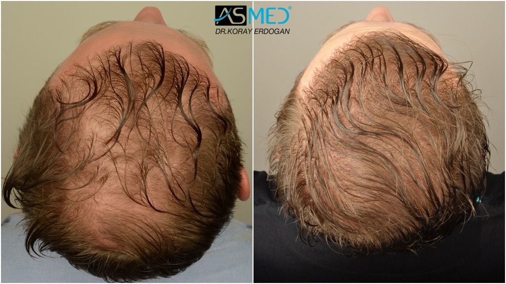 6902 (2700 FUE + 4202 FUE) Grafts Fue | Norwood 5 | Asmed Hair Transplant  Results