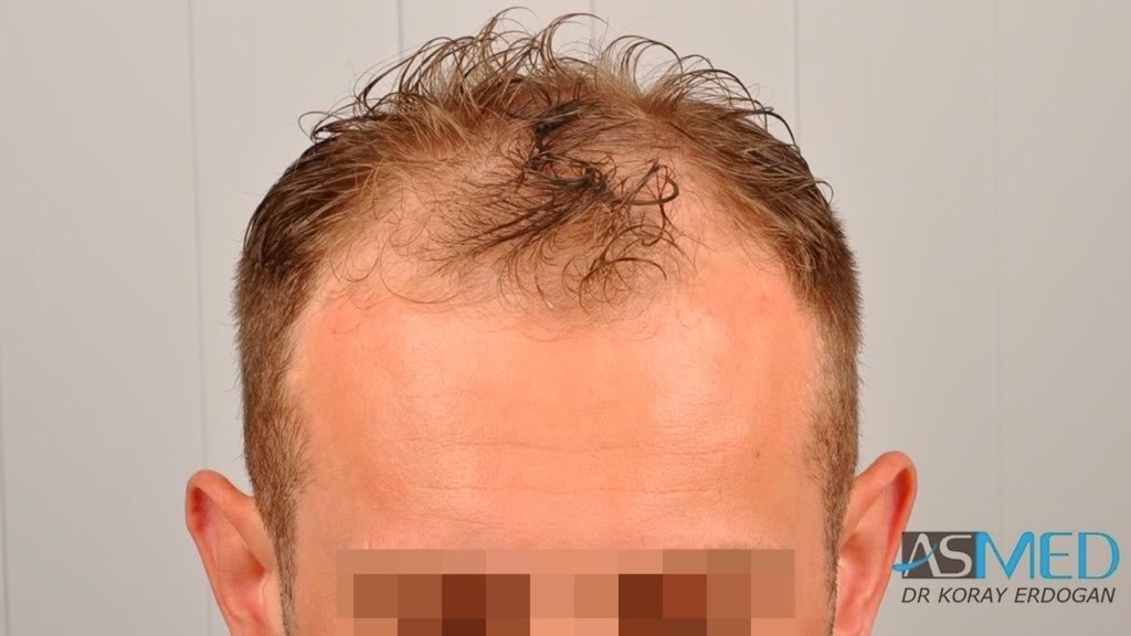 6902 (2700 FUE + 4202 FUE) Grafts Fue | Norwood 5 | Asmed Hair Transplant Results 6902 (2700 FUE + 4202 FUE) Grafts Fue | Norwood 5 | Asmed Hair Transplant Results