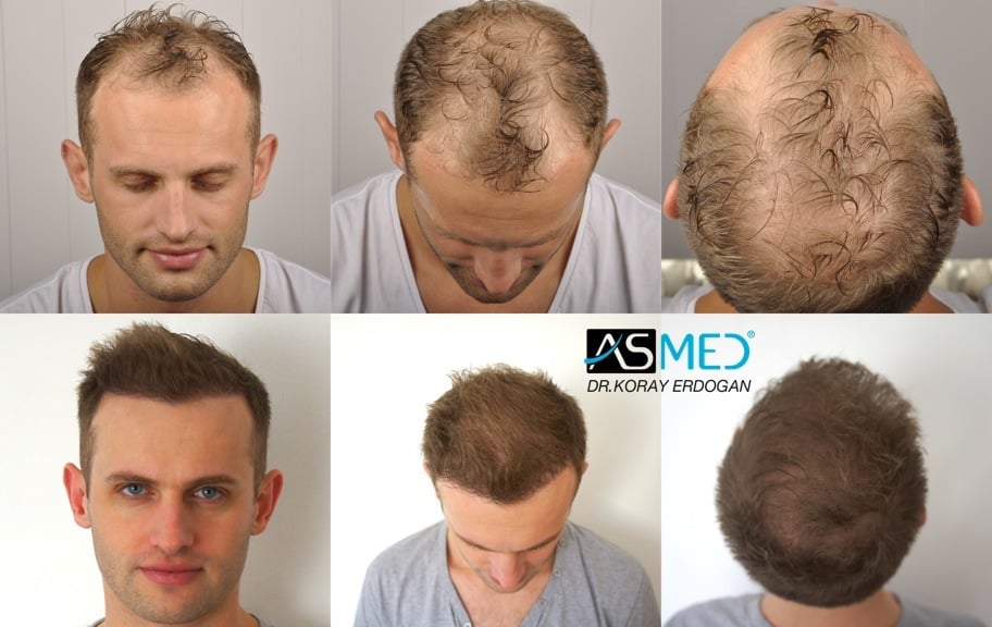 Norwood 5 Hair Transplantation Results Asmed Hair Transplant