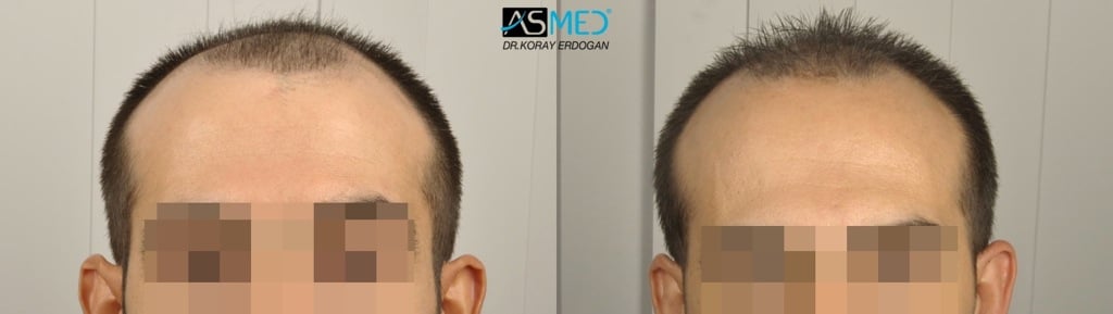 Norwood 5 Hair Transplantation Results | Asmed Hair Transplant Norwood 5 Hair Transplantation Results | Asmed Hair Transplant