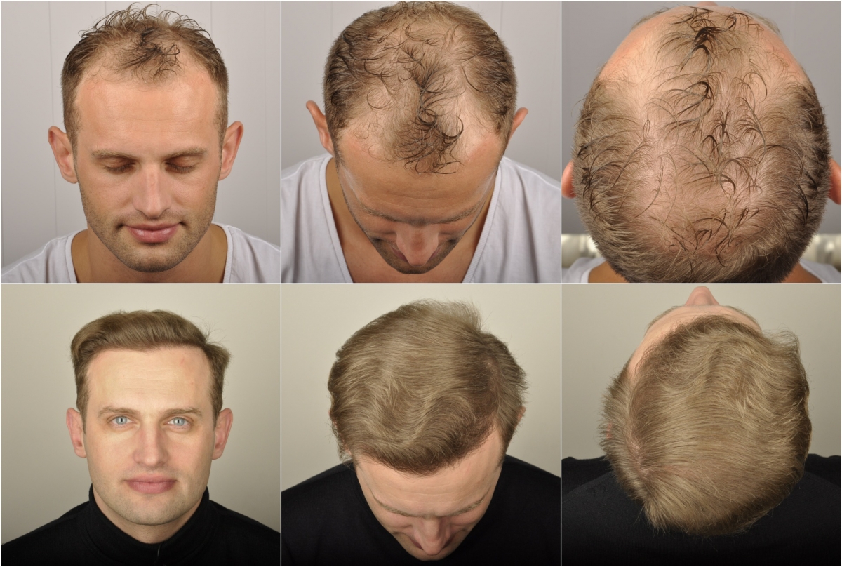 hair transplants results