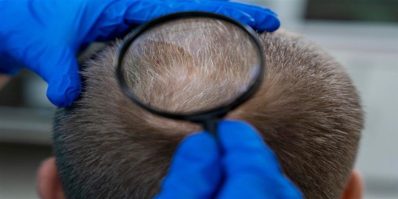 What is Diffuse Thinning?
