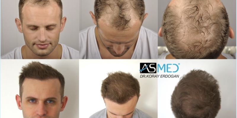 Hair Transplant Turkey Results