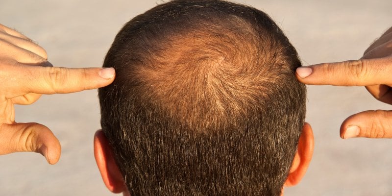 What Is Male Pattern Baldness?