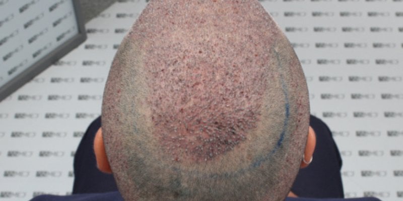 Crown Hair Transplant Timeline