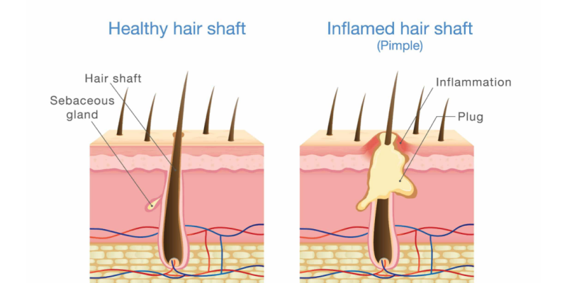 Folliculitis After Hair Transplant